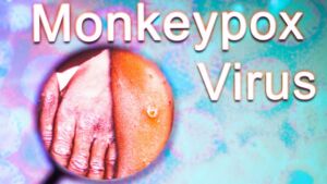 Monkeypox virus